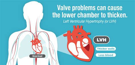 lvh medical abbreviation|surgery for lvh.